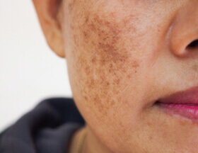 Melasma no Rosto